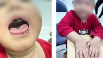 Ngáy to tưởng bình thường, bé trai 4 tuổi phát hiện mắc hội chứng nguy hiểm