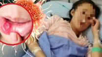 Cô gái 26 tuổi 'chết lặng' phát hiện ung thư giai đoạn 3 khi khám nhiệt miệng