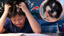 Ôn thi căng thẳng, bé trai tự nhổ tóc đến trơ từng mảng da đầu