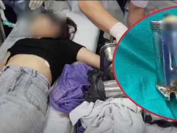 Cô gái 19 tuổi bị máy xay thịt cuốn nát bàn tay, bác sĩ buộc phải cắt bỏ chi