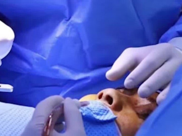 Nâng mũi xong gặp tai nạn, người phụ nữ đối mặt nguy cơ hoại tử mũi