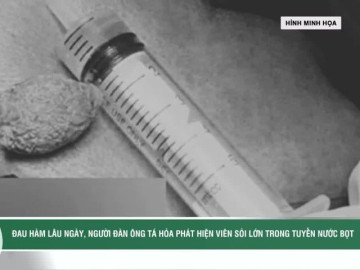 Đau hàm lâu ngày, người đàn ông tá hỏa phát hiện viên sỏi lớn trong tuyến nước bọt