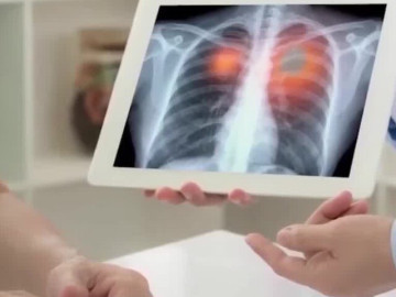 Người đàn ông phải tái tạo đường thở vì ung thư sau 30 năm nghiện thuốc lào
