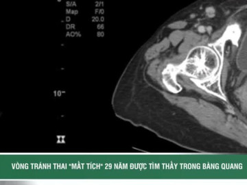 Vòng tránh thai 'mất tích' 29 năm bất ngờ được tìm thấy trong bàng quang