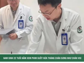Nam sinh 22 tuổi nằm xem phim suốt nửa tháng, chân sưng như chân voi