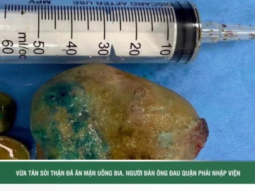 Vừa tán sỏi thận đã ăn mặn uống bia, người đàn ông đau quặn thận