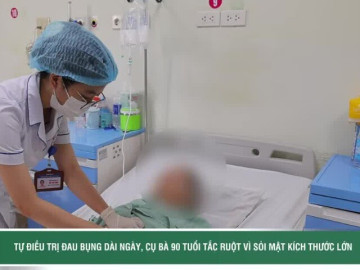 Tự điều trị đau bụng dài ngày, cụ bà tắc ruột vì sỏi mật kích thước lớn