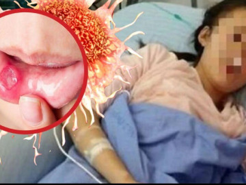Cô gái 26 tuổi 'chết lặng' phát hiện ung thư giai đoạn 3 khi khám nhiệt miệng