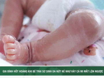 Gia đình hốt hoảng khi bé trai sơ sinh da nứt nẻ như vảy cá