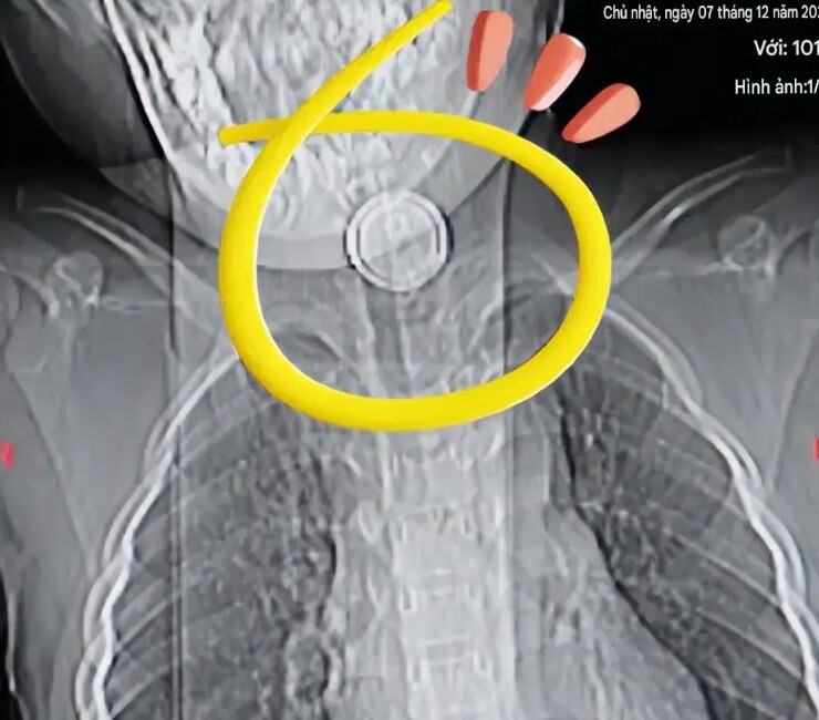 Hình ảnh viên pin cúc áo trong cổ họng của em bé