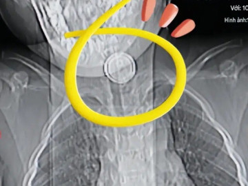 Yêu con - Cháu nuốt nhầm pin cúc áo, bà nội cố gắng gây nôn nhưng mẹ đứa trẻ cản, BS khen: Chị rất thông minh!