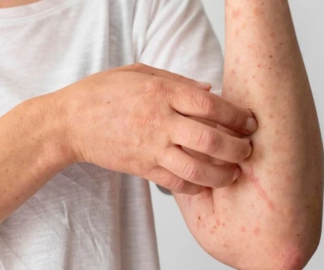 Các biểu hiện ngứa ngáy trên cơ thể không đơn giản chỉ là dị ứng thời tiết, mà đôi khi là dấu hiệu cảnh báo bệnh thận. Ảnh minh họa. 
