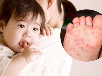 Cả nước ghi nhận hơn 3.000 ca tay chân miệng mỗi tuần, Bộ Y tế cảnh báo
