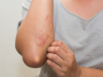 Cơn ngứa “chợt đến rồi đi” vô cùng khó chịu, nhiều người nghĩ gan có vấn đề nhưng lý do thật sự lại...