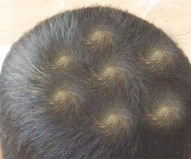 Đầu con trai bỗng xuất hiện 7 vòng xoáy kỳ lạ, người mẹ lo lắng đưa đến viện khám, bác sĩ không nói nên lời - 1