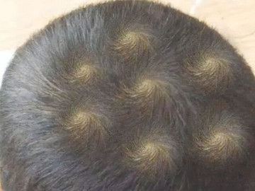 Đầu con trai bỗng xuất hiện 7 vòng xoáy kỳ lạ, người mẹ lo lắng đưa đến viện khám, bác sĩ không nói nên lời
