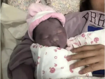 Con vừa chào đời đã có làn da tím khác thường, bố mẹ lo lắng, nào ngờ 2 tháng sau nhận không ra con