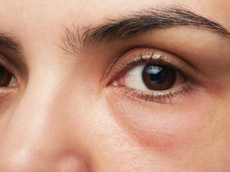 Phù nề do thừa muối khiến tình trạng bọng mắt, sưng mắt rõ mồn một.