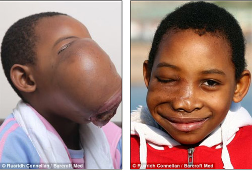 Khối u 2 kg trên mặt biến bé gái thành #039;Ngưu Ma Vương#039; - 1