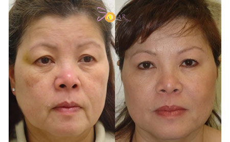 Níu giữ tuổi xuân với công nghệ căng da mặt - 2