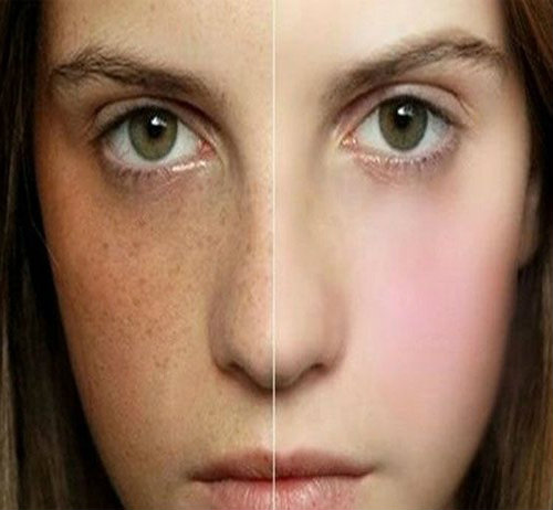 Trị tàn nhang tại nhà hiệu quả cho bạn gái thêm tự tin - 1