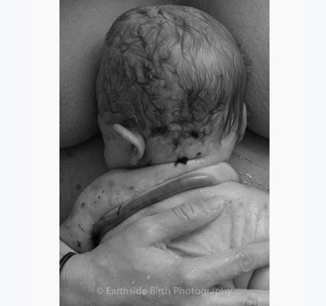 Hình ảnh một em bé chào đời khi dây rốn còn quấn qua cổ và tay.
