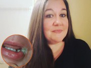 Làm mẹ - Bà mẹ vô ý quên rút dây sạc điện thoại khiến con 19 tháng bị bỏng nặng