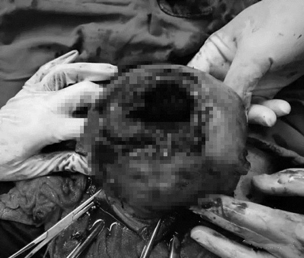 Mẹ bầu 8 tháng suýt mất mạng vì thai nhi đạp thủng tử cung, chân thò ra ngoài - 2