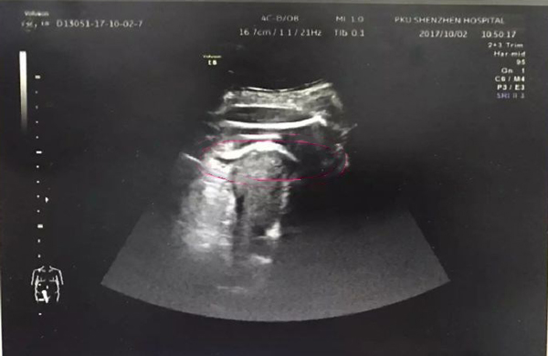 Mẹ bầu 8 tháng suýt mất mạng vì thai nhi đạp thủng tử cung, chân thò ra ngoài - 1