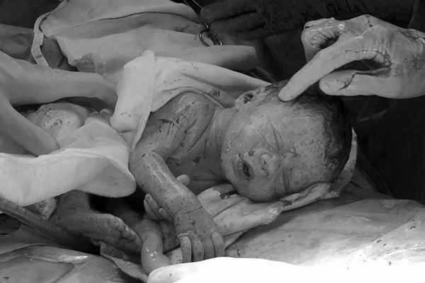 Kỳ diệu ca sinh mổ 3 thai với một bé nằm nguyên trong bọc ối - 4