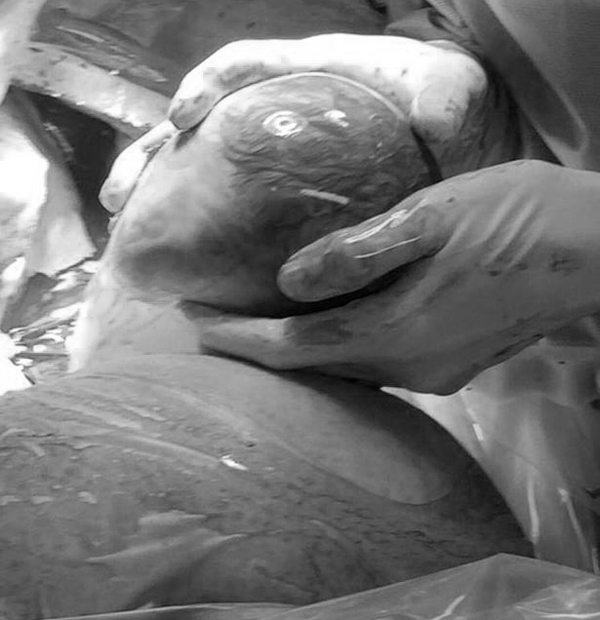 Kỳ diệu ca sinh mổ 3 thai với một bé nằm nguyên trong bọc ối - 3