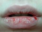 Làm đẹp - Bỏ túi 3 cách dưỡng môi khô nứt trở nên mềm mịn, căng mướt khi trời chuyển mùa hanh khô