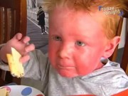 Tin tức - Bé trai có làn da đỏ ứng, đi đâu người lạ cũng nghĩ bị bố mẹ bạo hành