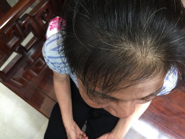 Tóc rụng quanh năm mà không biết mẹo này nên mãi mỏng và thưa - 2