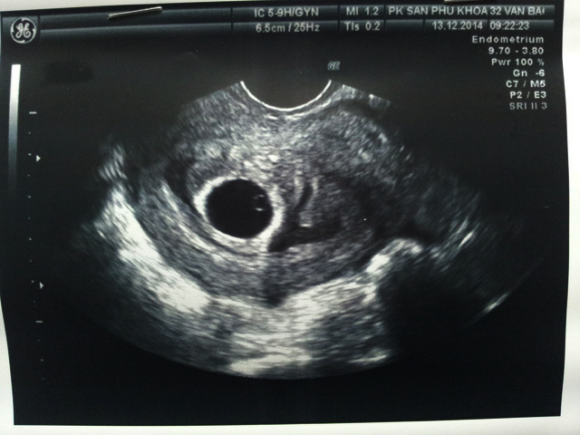 Thai nhi 5 tuần tuổi đã vào tử cung chưa?