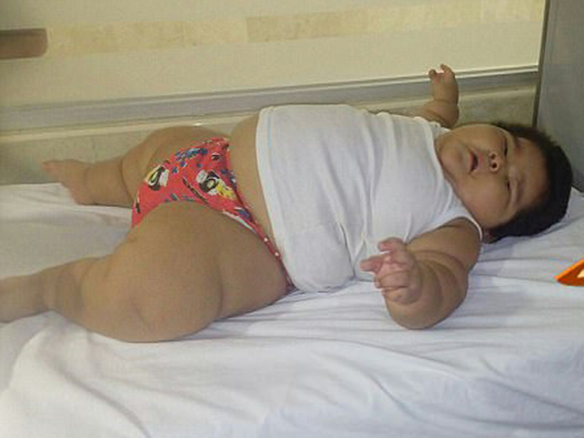 Bé trai 10 tháng mang cân nặng của trẻ 9 tuổi, không thể ngủ vì quá béo