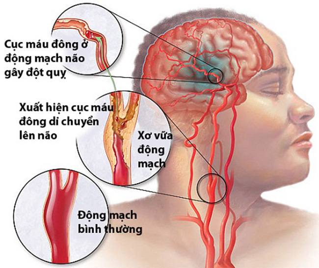 Cảnh báo những cái chết do đột quỵ ở người trẻ - 1
