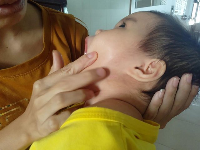 Bé gái 13 tháng tuổi bị teo não, nhiễm trùng máu vì bị côn trùng đốt vào tai - 3
