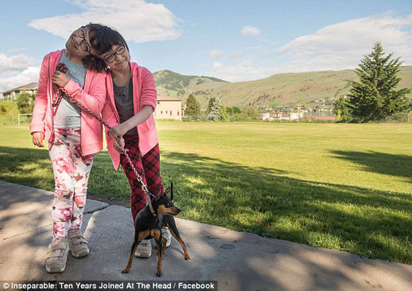 Cuộc sống của cặp song sinh liền đầu biết mọi suy nghĩ của nhau nhưng tính cách trái ngược - 5