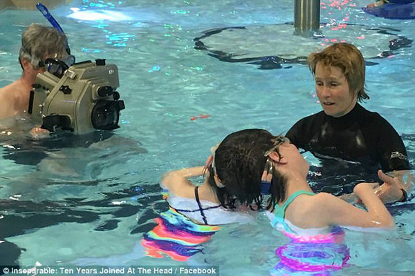 Cuộc sống của cặp song sinh liền đầu biết mọi suy nghĩ của nhau nhưng tính cách trái ngược - 7