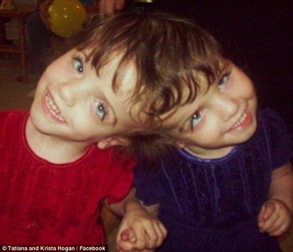 Cuộc sống của cặp song sinh liền đầu biết mọi suy nghĩ của nhau nhưng tính cách trái ngược - 9