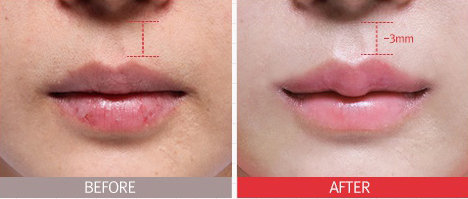 Trào lưu môi amp;#34;tềuamp;#34;: làm sao để không xảy ra sự cố đáng tiếc như HH Đại Dương Ngân Anh? - 2
