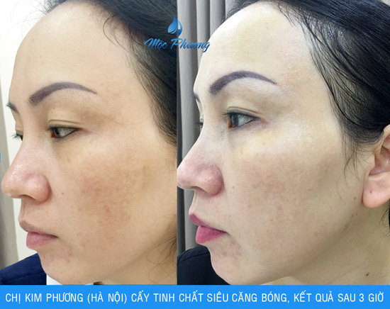 Thẩm mỹ Mộc Phương tung khuyến mãi “khủng” mừng ngày Nhà giáo Việt Nam - 6
