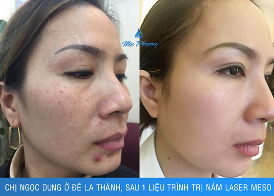 Thẩm mỹ Mộc Phương tung khuyến mãi “khủng” mừng ngày Nhà giáo Việt Nam - 2