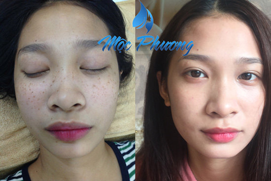 Thẩm mỹ Mộc Phương tung khuyến mãi “khủng” mừng ngày Nhà giáo Việt Nam - 5