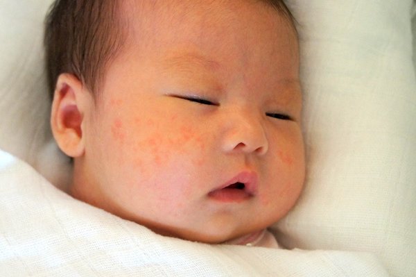 Trẻ sơ sinh nổi mẩn đỏ như muỗi đốt nên chăm sóc như thế nào? - 1