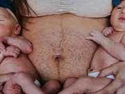 Bà bầu - Nhìn vùng bụng "nhàu nhĩ" sau sinh của mẹ, con trai lớn ngạc nhiên: "Bụng mẹ bị làm sao vậy?"