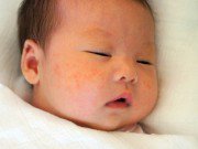 Làm mẹ - Trẻ sơ sinh nổi mẩn đỏ như muỗi đốt nên chăm sóc như thế nào?