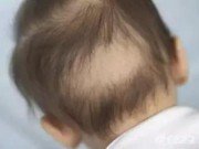 Tin tức - Bé trai 2,5 tuổi bị hói đầu vì học thêm nhiều khiến bác sĩ phải thốt lên: “Tôi bị sốc”