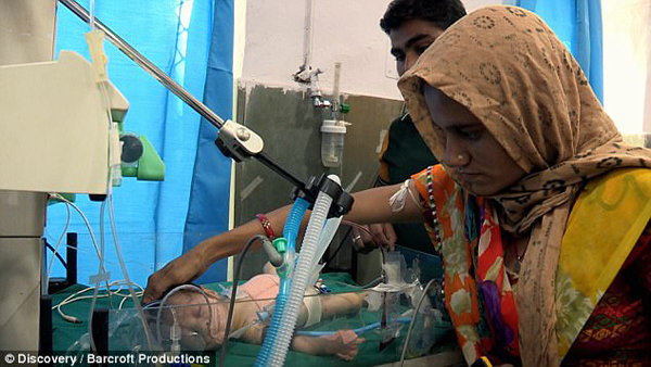 Chào đời với người anh em ký sinh dính liền bụng, bé trai 9 ngày tuổi được tách rời - 3